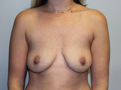 Breast Explant Results Dallas